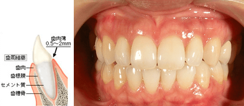 歯肉 炎 治療
